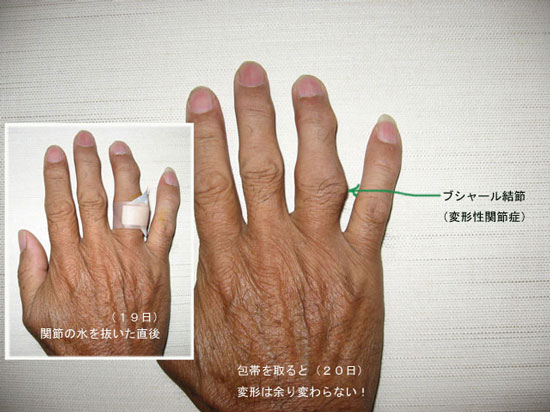 原因 ブシャール 結節