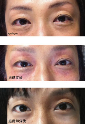 cosmoeye_norie3 もともと蕁麻疹