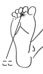 しもやけ