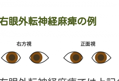外転神経麻痺になっちゃった ヒーリングスペースiruka ブログ
