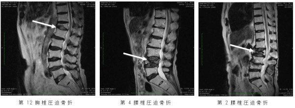 圧迫骨折