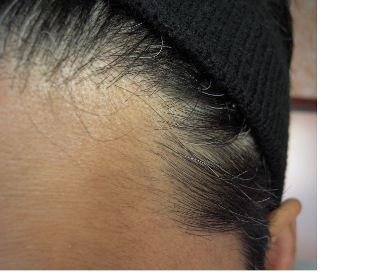 ミノタブ100日服用の効果です ミノタブと育毛サプリメントで発毛 副作用と戦う薄毛対策日記