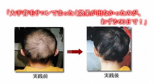 発毛 育毛 小林弘子さんの奇跡のフサフサ発毛術の評判 口コミ 効果