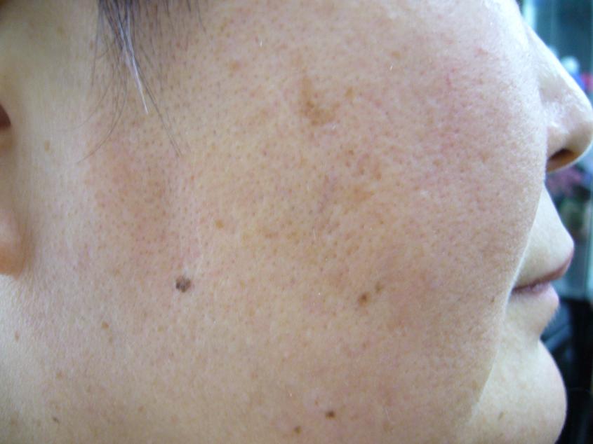 しみ ほくろ イボ 名古屋まつげｴｸｽﾃ専門be Style Owners Blog