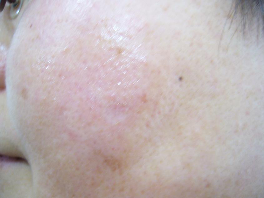 しみ ほくろ イボ 名古屋まつげｴｸｽﾃ専門be Style Owners Blog