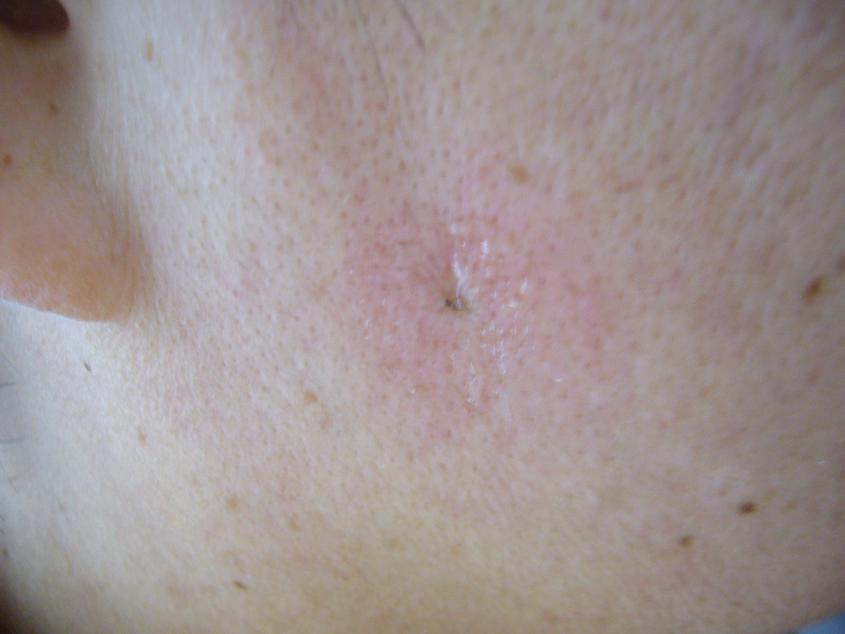 しみ ほくろ イボ 名古屋まつげｴｸｽﾃ専門be Style Owners Blog