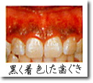 着色した歯ぐき
