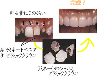 ラミネートベニアとセラミッククラウン