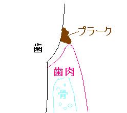 歯周組織縁上プラーク