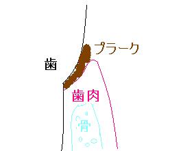 歯周組織縁下プラーク