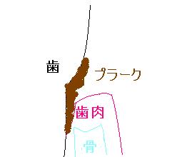 歯周病悪化