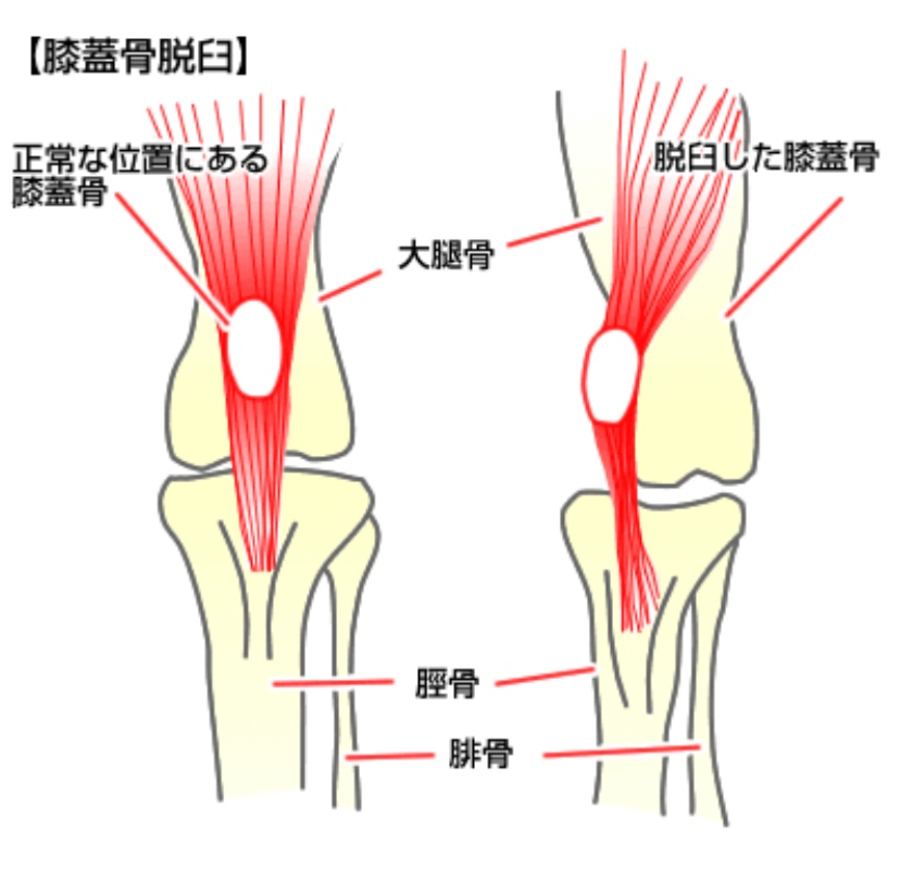 犬 膝蓋骨脱臼(パテラ)の図