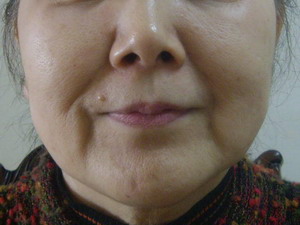 症例写真 お客様の声 エンビロン アンチエイジング ニキビ フェイシャル 愛知県