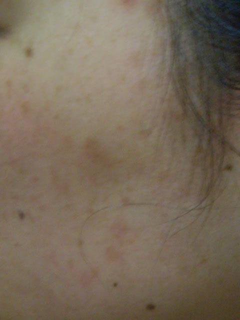 しみ そばかす くすみ ニキビ痕 ３か月後 エンビロン アンチエイジング ニキビ フェイシャル 愛知県