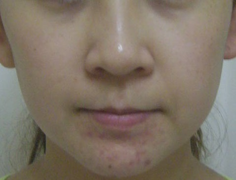 31才 顎にきび にきび痕 目の下の色素沈着 6カ月後はニキビ改善と潤い 透明感 エンビロン アンチエイジング ニキビ フェイシャル 愛知県