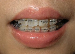 Braces