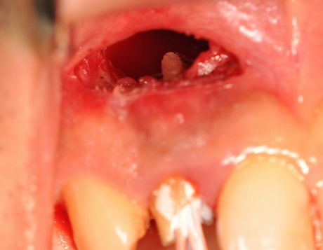 嚢胞 治療 歯根 放置すると抜歯することになる？歯根嚢胞の症状と治療方法