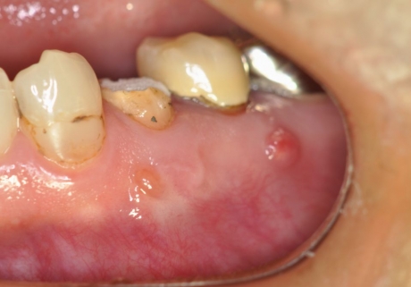 が 奥 の 腫れる 歯茎 奥歯の歯茎が腫れる3つの原因と応急処置