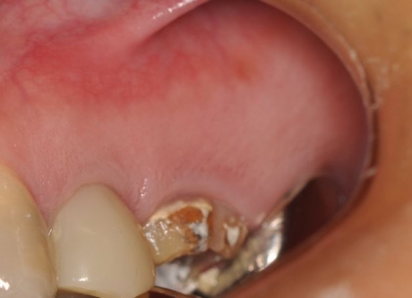 フィステル 歯茎のできものフィステルを撃退する5つの方法