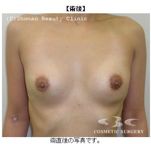 プチ豊胸施術後