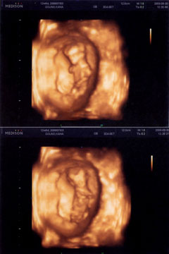 12w5d