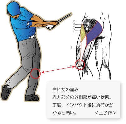 ゴルフインパクト後の左ヒザ痛 Tsuchikoカイロプラクティック オフィス ゴルファーズクリニック