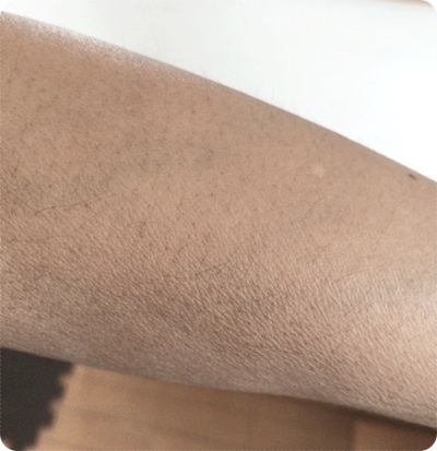 400左腕脱毛前汚い.jpg