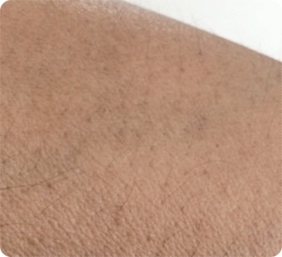 400左腕脱毛前汚いアップ.jpg