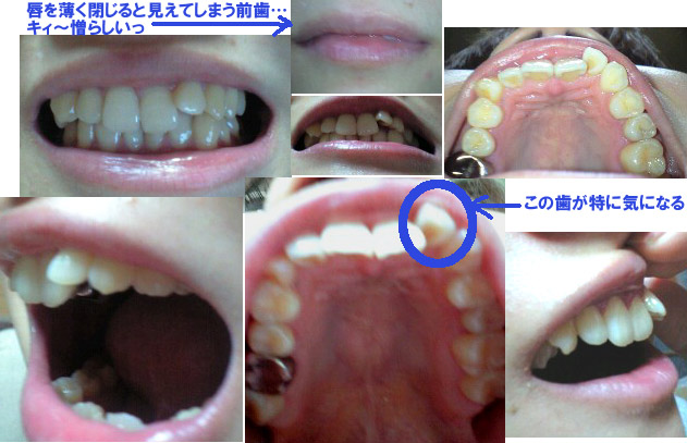 ３０代ol 床矯正ライフ スタートします 三十路女 大人の歯列矯正 床矯正 日記