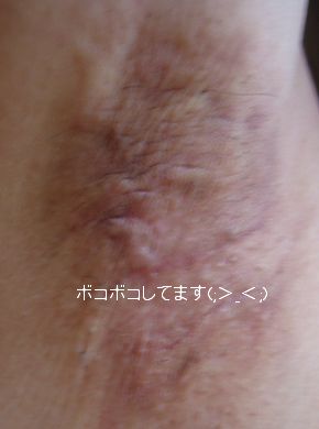 ボコボコ