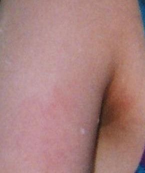 ワキの黒ずみ 画像で紹介 ワキガ手術体験レポート By わきぶー 経過写真もあるよ