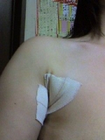 ワキガ手術後