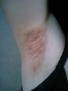 おちびさんワキガ手術6ヶ月の画像 色白は色素沈着が目立つ ワキガ手術体験レポート By わきぶー 経過写真もあるよ