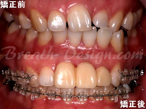 前歯の歯列矯正治療 - 前歯が1本足りない | 新潟長岡の歯科相談室