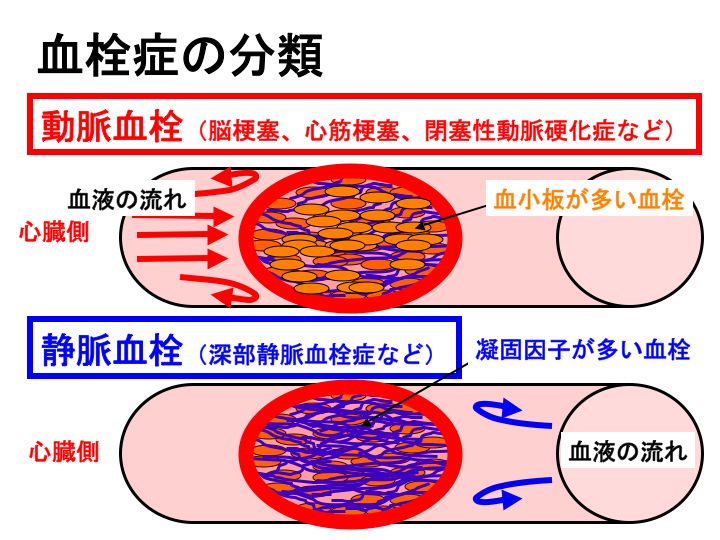 静脈血栓症の症状